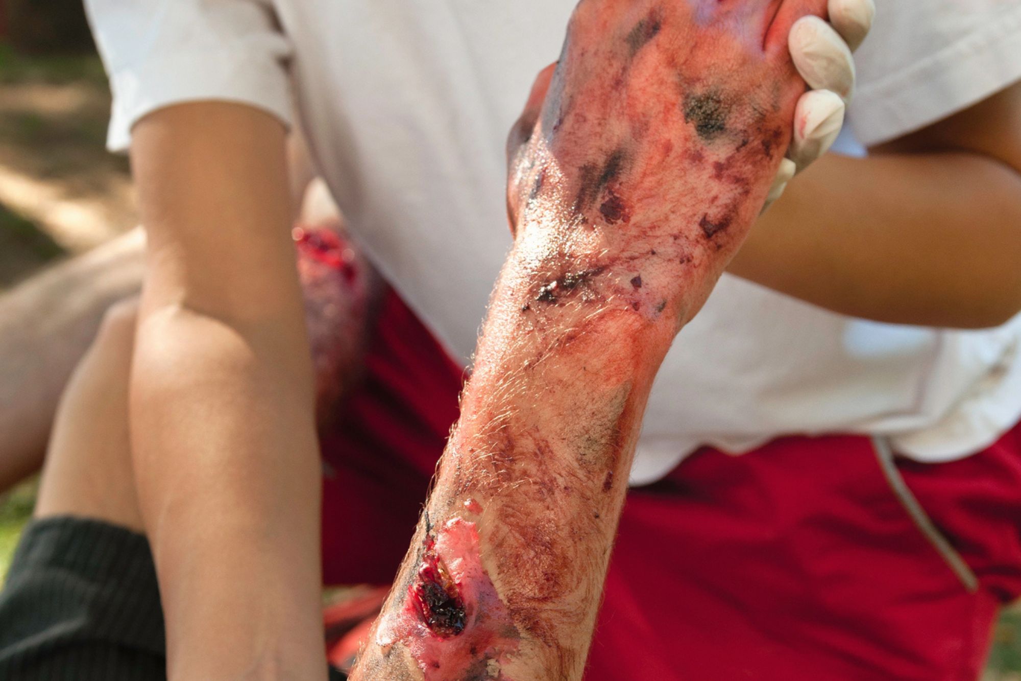 personal injury lawyer Plantation, FL